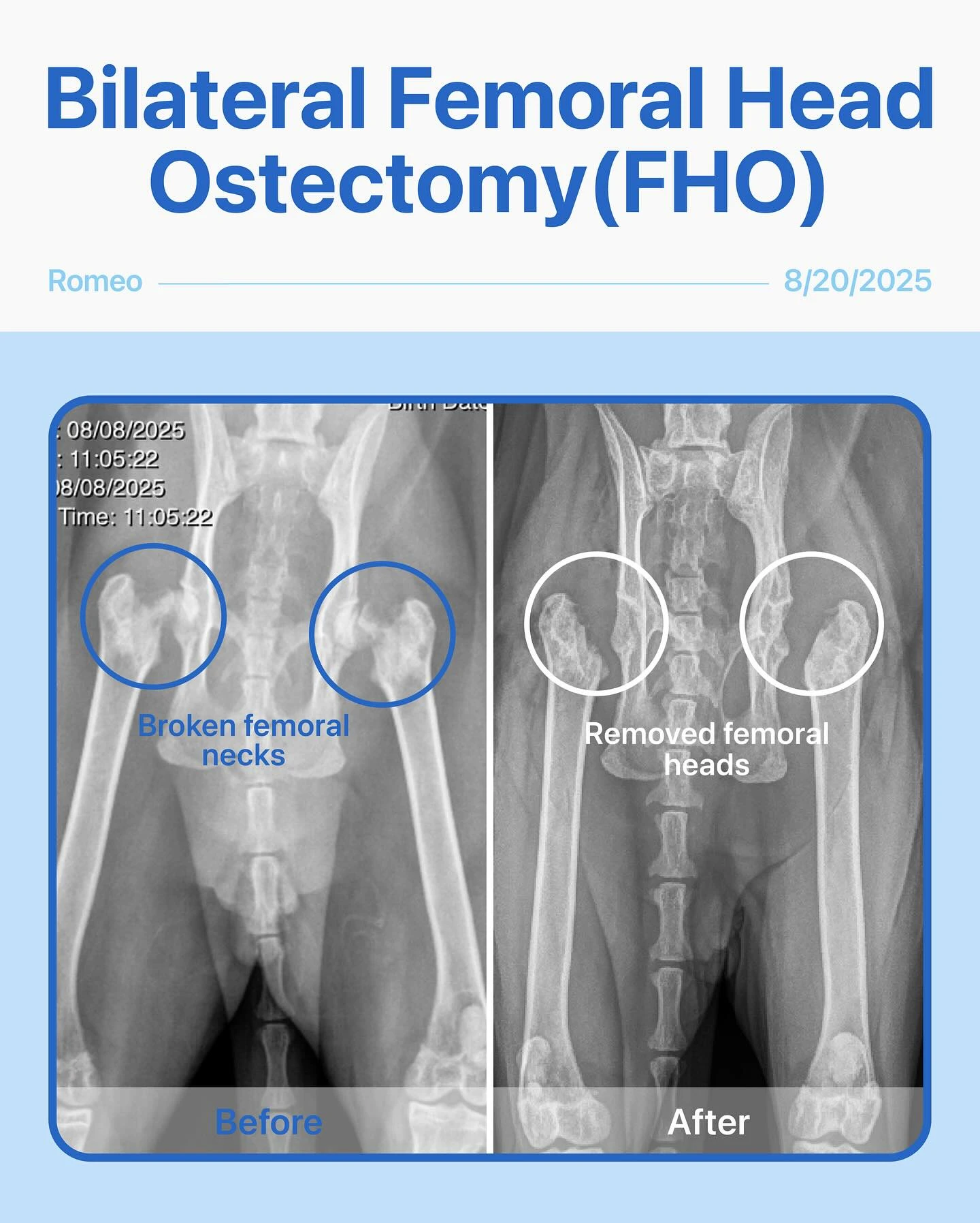 Femoral Head Ostectomy – Romeo