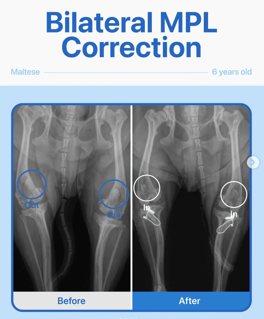 Bilateral MPL Correction – Maltese
